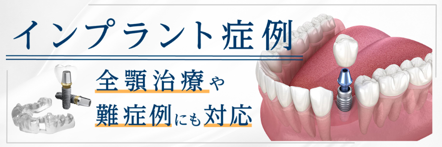 インプラント症例 全顎治療や難症例にも対応